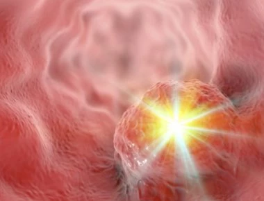 Πολλοί αγνοούν σαν «κάτι περαστικό» αυτά τα πρώιμα συμπτώματα καρκίνου του στομάχου